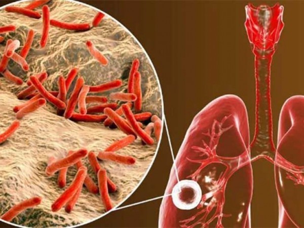 Cinco personas han fallecido en Maldonado a causa de tuberculosis en lo que va de 2024