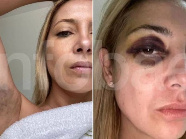 El ex médico presidencial confirmó que vio el moretón en el ojo de Fabiola Yañez y que el Presidente le dijo que había sido un golpe involuntario
