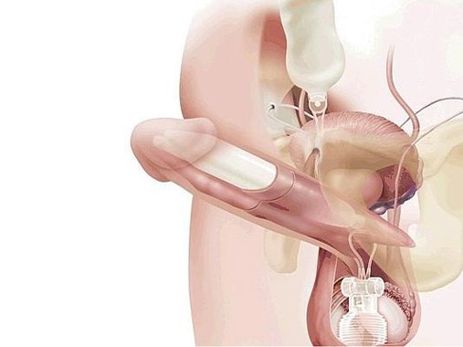 Inédita operación en Uruguay: Cómo funciona la prótesis hidráulica de pene,  que cuesta US$ 10 mil