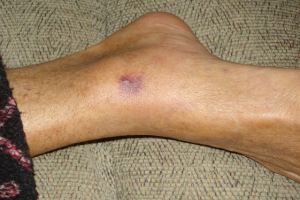 Salud Pública investiga y monitorea infección bacteriana en bañistas 