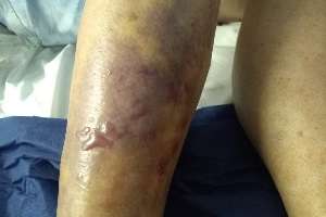 Paciente que murió por la bacteria Vibrio Vulnificus se infectó en Jareguiberry tras pincharse con un junco