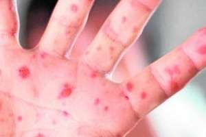 Sarampión: en Maldonado todavía no hay ningún caso sospechoso, dijo Araújo