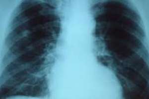 Enfermedades respiratorias: disminuyeron infecciones, internaciones y muertes en Maldonado 