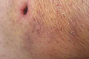 Mujer fue atacada y mordida por perros sueltos en Piriápolis