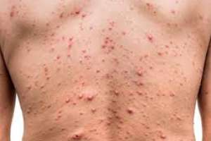 Primer caso de la denominada viruela del mono en Uruguay; el paciente se encuentra estable