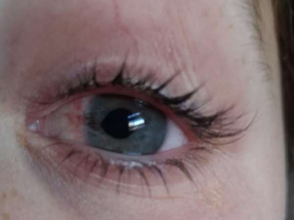 Niña fue operada luego de recibir impacto de un lápiz en su vista