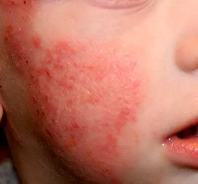 Dermatitis atópica:...
